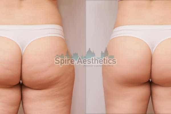 before and after cryolipolysis 1 1