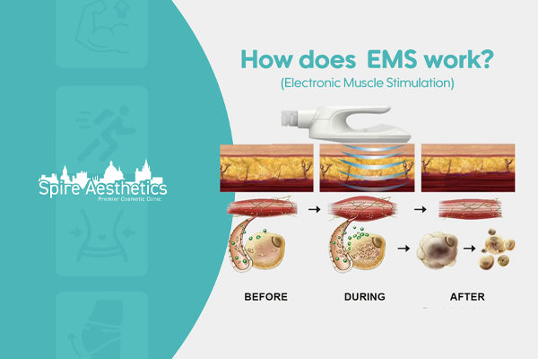 EMS treatment for post pregnancy weight loss treatment Leeds