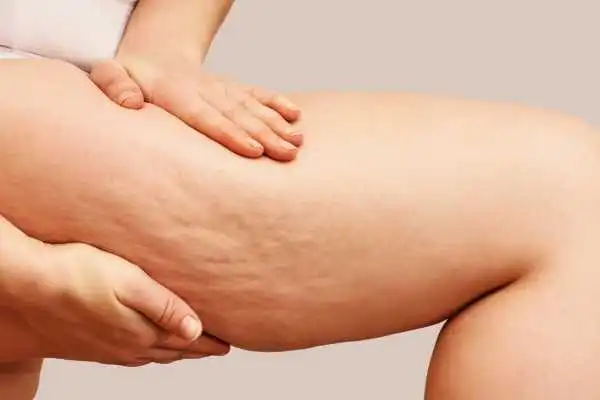 Image of woman showing leg with cellulite Leeds