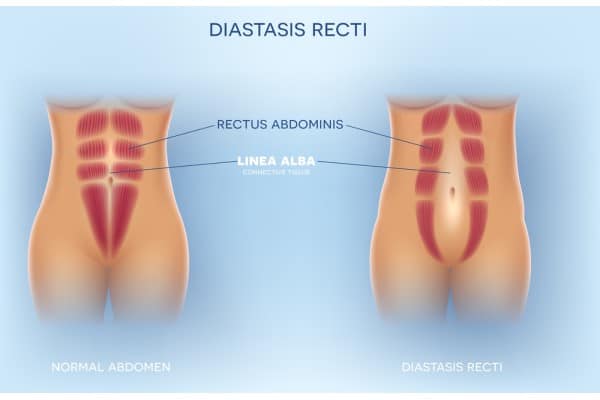 What Non-Surgical Options Are Available for Diastasis Recti Leeds?