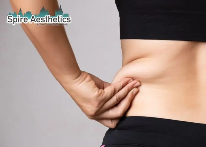Image of woman pinching fat on their hips Leeds. Fat Freezing treatment
