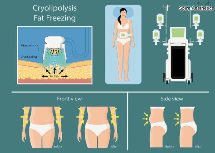 Image of diet and fat freezing combined for best results for Spire Aesthetics Leeds