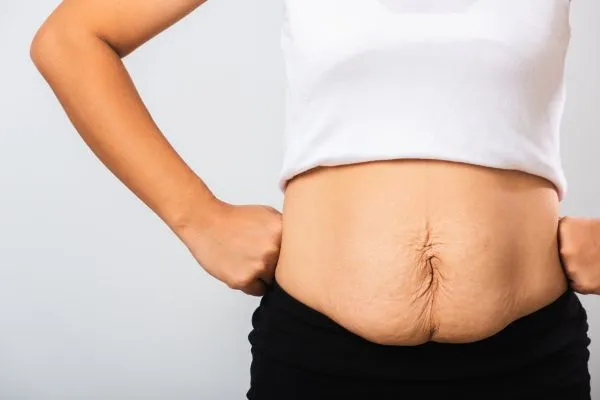 Image of a woman's stomach after weight loss with sagging skin following a gastric band Leeds