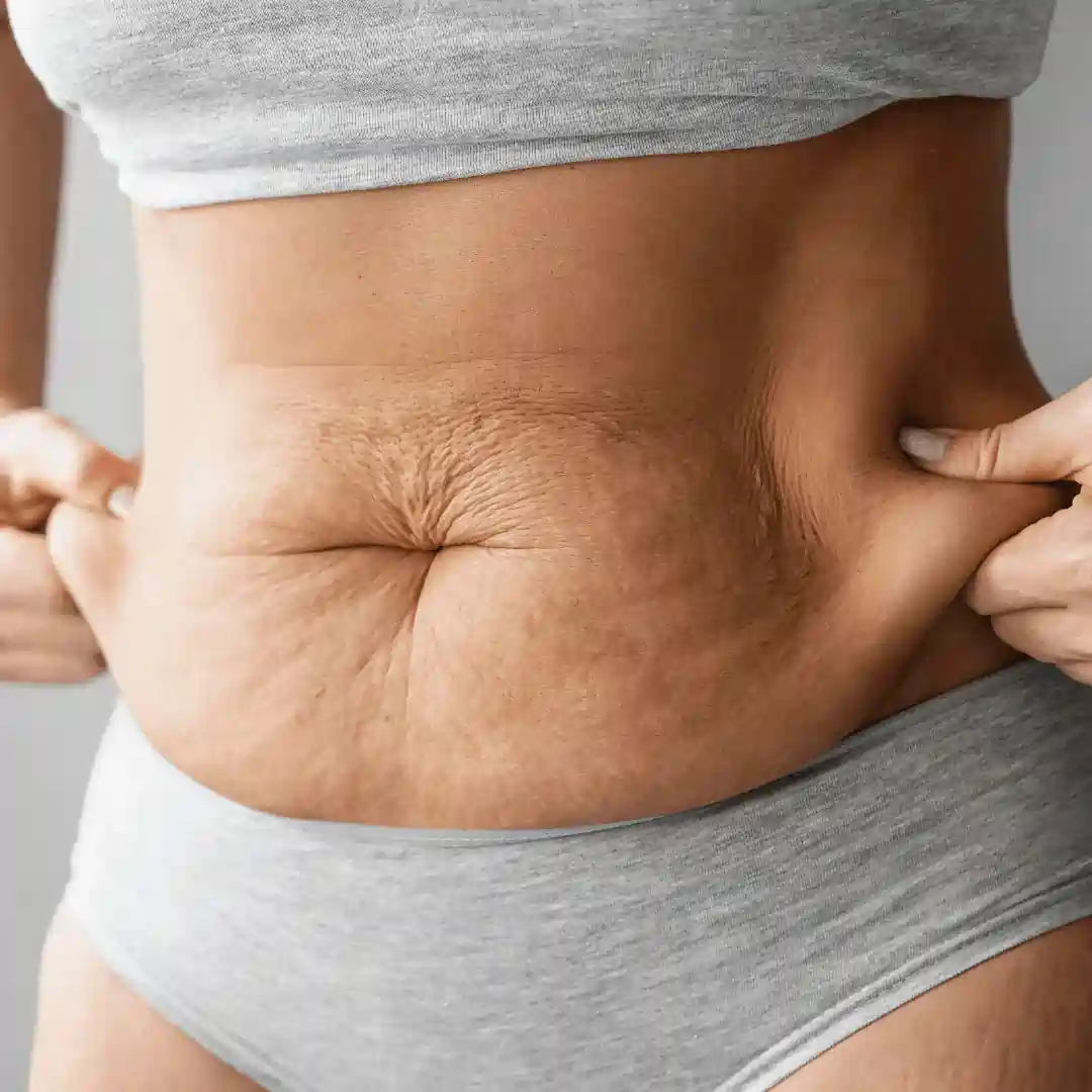 Is It Normal to Have Loose Skin After Pregnancy Leeds?
