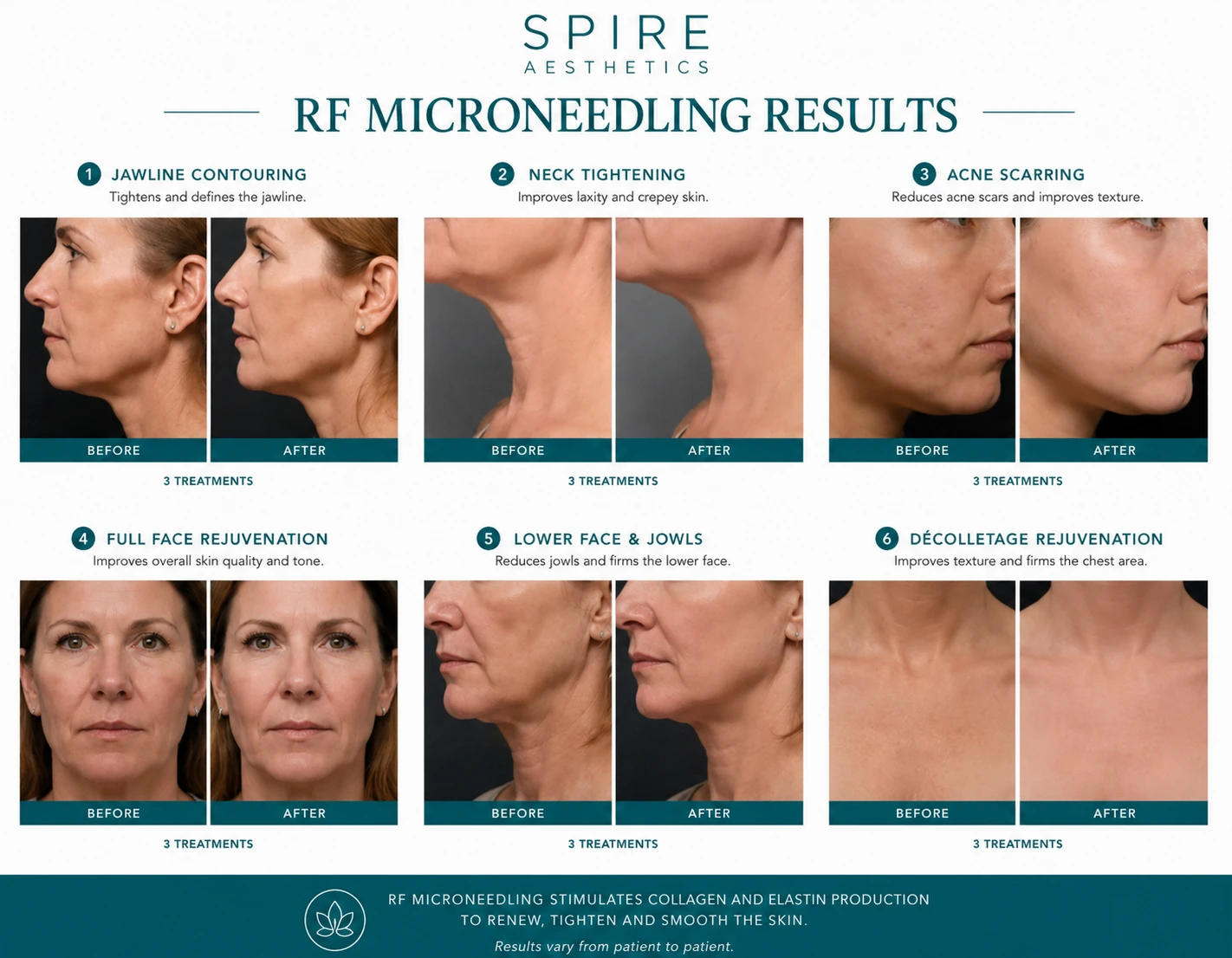 RF Microneedling Skin tightening Leeds results