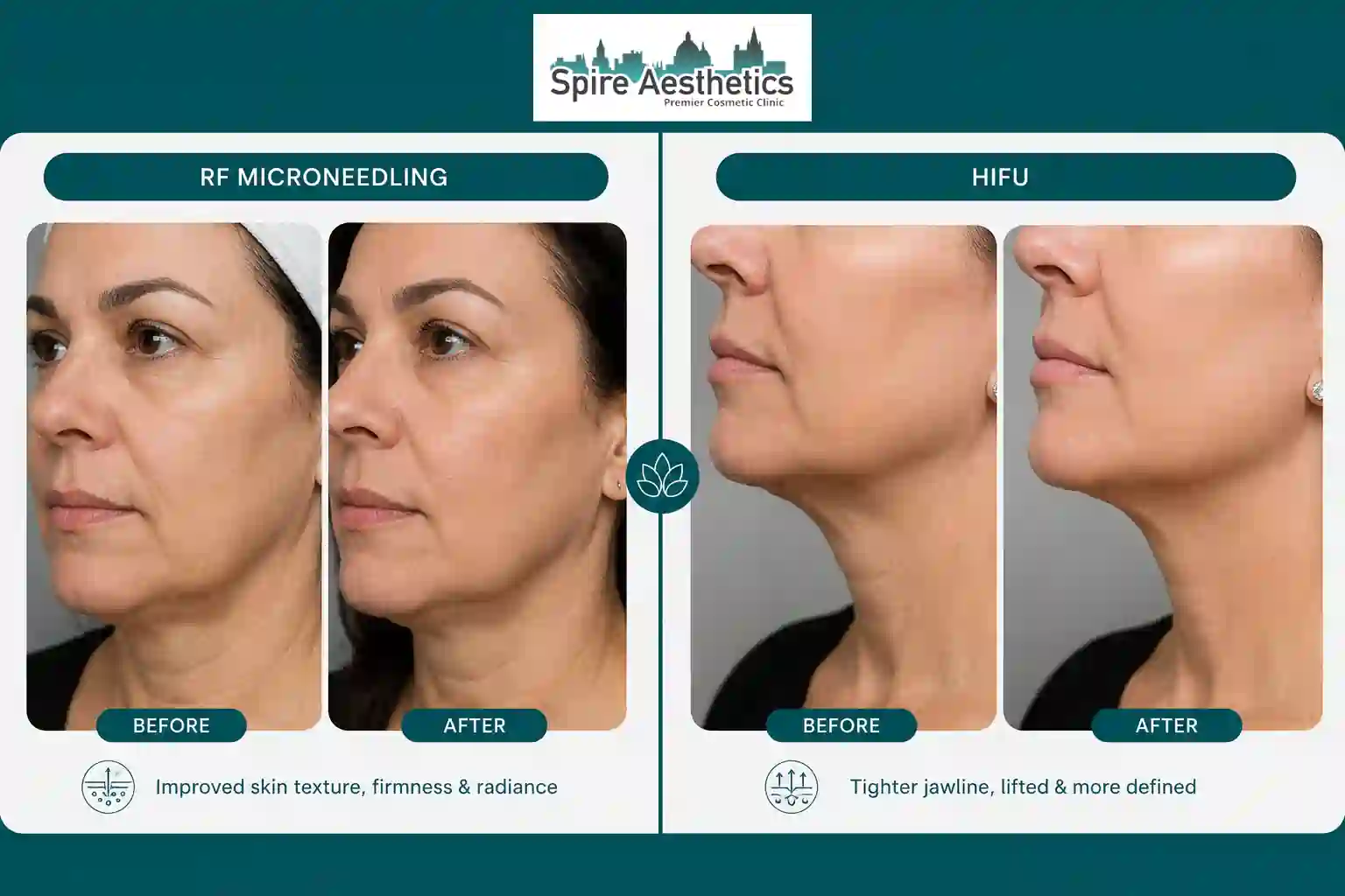 Can RF Microneedling and HIFU Be Combined Leeds?