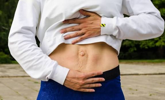 When Could Diastasis Recti Be the Missing Piece of the Puzzle Leeds?