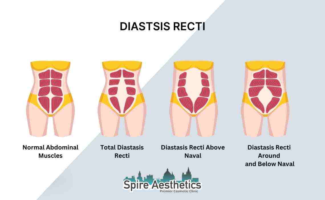 Is Non-Surgical Diastasis Recti Treatment Right for You? Common Concerns Answered Leeds